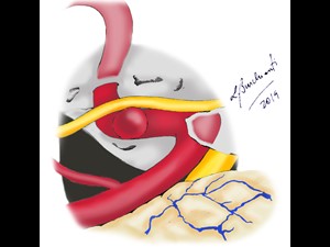 Aneurisma Intracraniano