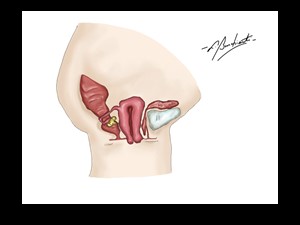 Prolapso uterino